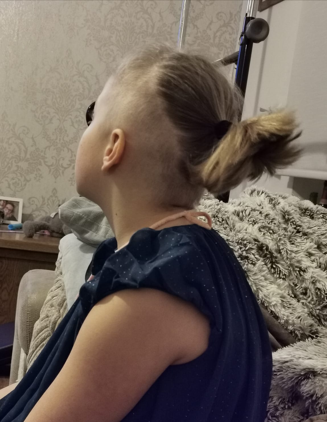 Isla George sufffers with trichotillomania, a hair pulling condition.